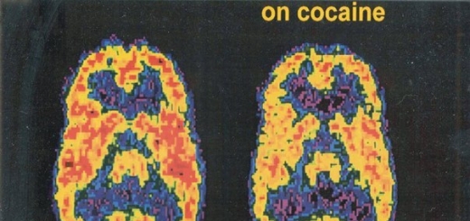 От кокаиновой зависимости научились избавлять глубокой стимуляцией мозга